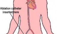 Kateter Ablasyon-AT Ablasyon Nedir?-What is Catheter Ablation | AT Ablation?