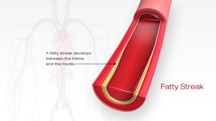 2- atherosclerosis nedir,damar sertligi nedir?
