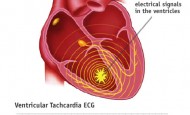 VENTRİKÜLER ARİTMİ- VENTRİKÜLER TAŞİKARDI- Ventricular Arrhythmia | Ventricular Tachycardia