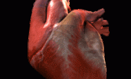 Cardiomyopathy | Dilated