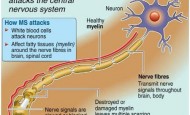 MS-Multipl Skleroz Nedir? What is Multiple Sclerosis?