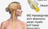 MS (Multipl Skleroz) Hastalığı Tedavisi Nasıl Yapılır? – How is MS Treatment made?