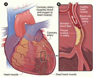 What Is a Coronary heart Attack?