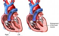 What is Cardiomyopathy | Hypertrophic
