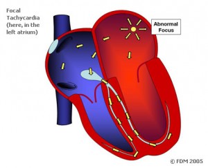 Taşikardi- tachycardia types Taşikardi- tachycardia types