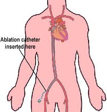 Kateter Ablasyon-AT Ablasyon Nedir?-What is Catheter Ablation | AT Ablation?