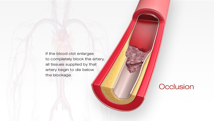 Atherosiklerosis – Damar tıkanıklığı nedir? Nasıl gerçekleşir?