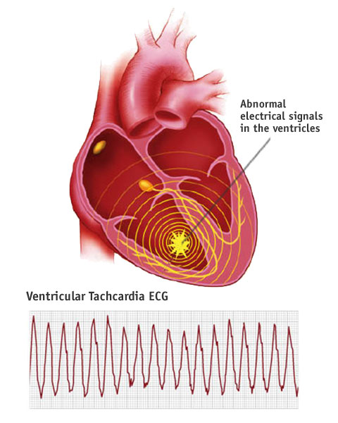VENTRİKÜLER ARİTMİ- VENTRİKÜLER TAŞİKARDI- Ventricular Arrhythmia | Ventricular Tachycardia